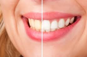 services teeth whitening